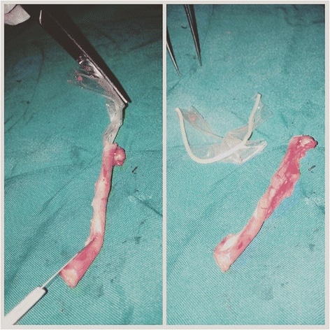 Condom fragment retrieved from appendiceal lumen © Sama et al. 2016 via BMC Journal of Medical Case Reports