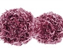 IASLC proposes new tumor budding-based grading system for lung squamous cell carcinoma