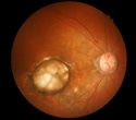 Cardiovascular risk scores predict future development of serious eye diseases