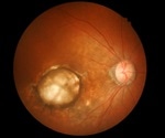 Inflammation control can protect against AMD-like retinal damage