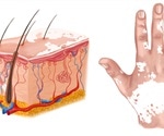 Vitamin Supplementation for Vitiligo