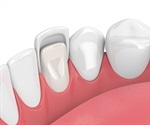Dental Veneers: Procedure and Safety
