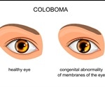 What is Coloboma?