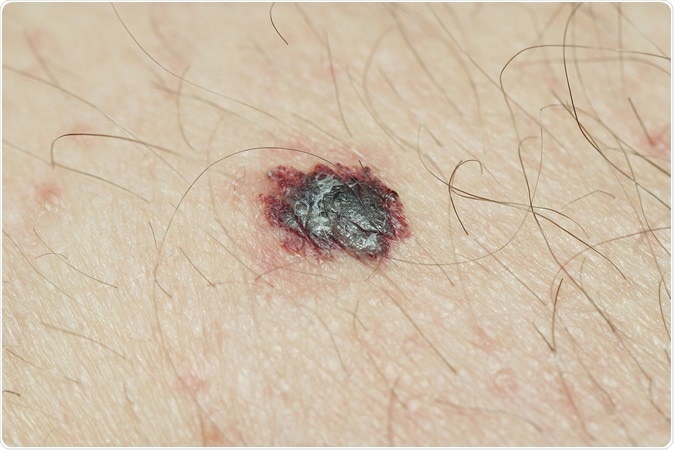 Melanoma - Image Credit: Krzysztof Winnik / Shutterstock
