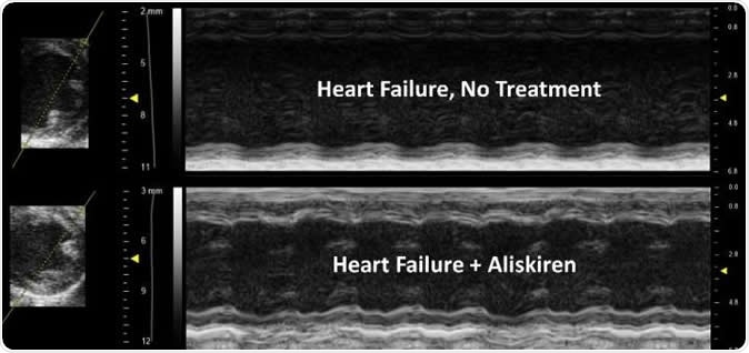 The treated image shows improved contractility of the heart, less ventricle/chamber dilation and improvement in wall thickness compared to the untreated heart. Image Credit: UA College of Medicine Phoenix
