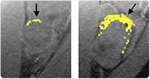 A tumor treated with fumagillin nanoparticles (left) is smaller than an untreated tumor. Nanoparticles containing an image-enhancing metal (yellow) show that the treated tumor has much less blood vessel growth than the untreated tumor. Image Credit: Washington University School of Medicine