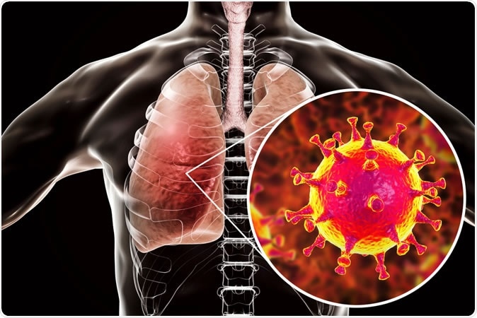 MERS virus, Middle-East Respiratory Syndrome coronavirus in human lungs, 3D illustration - Image Credit: Kateryna Kon/ Shutterstock