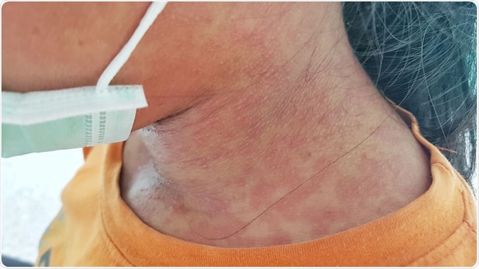 Rubella patient. Image Credit: Akkalak Aiempradit / Shutterstock