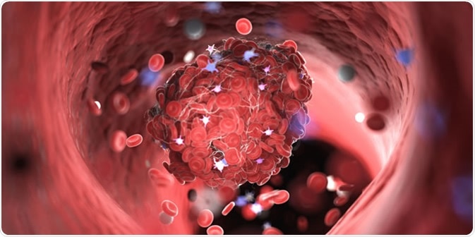 Illustration of a blood clot - Illustration Credit: Sebastian Kaulitzki / Shutterstock