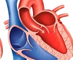 What is Aortic Stenosis?