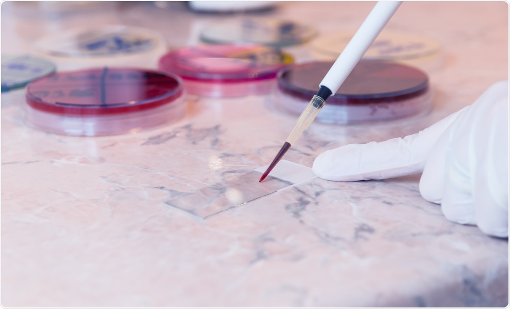 Blood smear - sickle cell disease diagnosis