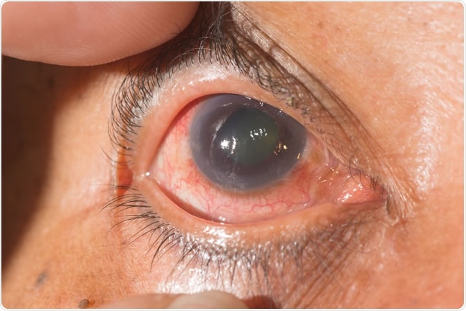 Close up of the neo vascular glaucoma during eye examination. Image credit: ARZTSAMUI / Shutterstock