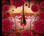 Some deadly skin cancers may originate in hair follicles
