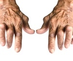 Rheumatoid arthritis: biologics useful in young and old alike