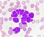Acute Myeloid Leukemia History