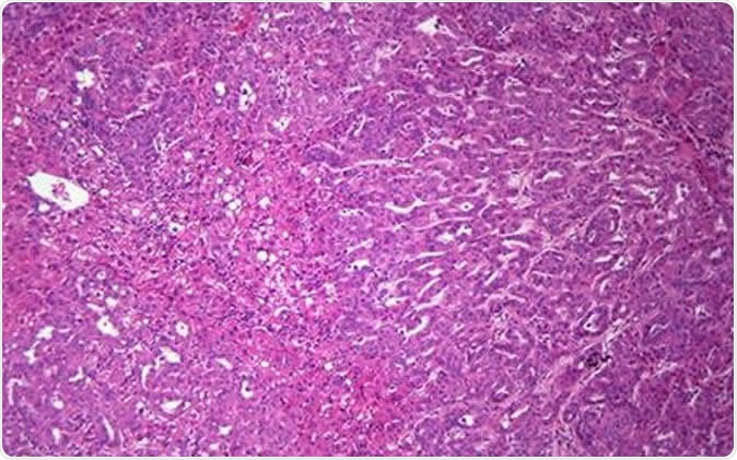UC San Diego School of Medicine researchers developed a mathematical equation to predict when healthy liver cells become cancerous before tumors are visible in a standard clinical setting.