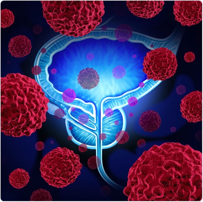 Prostate cancer danger medical concept illustration. Nearly one in six deaths from prostate cancer could be prevented if targeted screening was introduced for men at a higher genetic risk of the disease, according to a new UCL-led computer modelling study. Image Credit: Lightspring