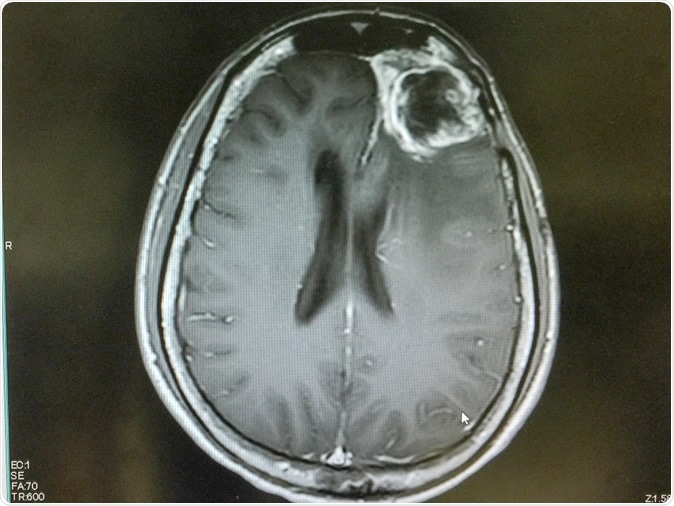MRI of brain showing left frontal gliblastoma. Image Credit: O_Akira / Shutterstock