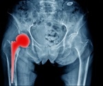 6 out of 10 hip replacements last 25 years or longer, according to a new study