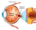 Types of Glaucoma