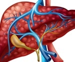 Managing and Treating Cirrhosis