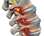 Spinal Stenosis Causes, Diagnosis & Management