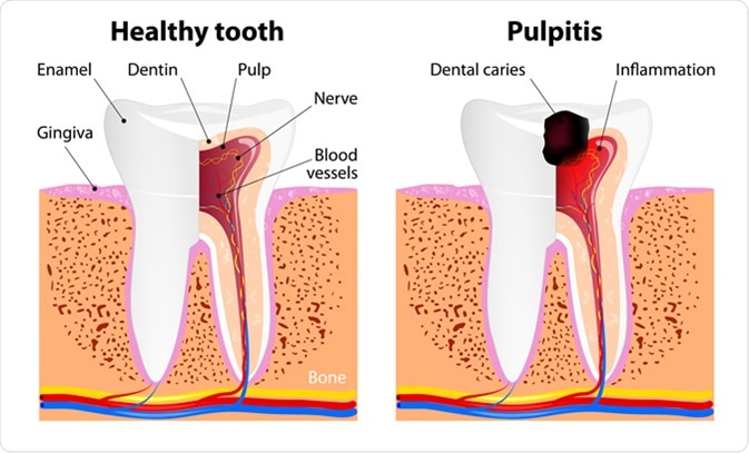 Pulpitis and Healthy tooth. Image Credit: Designua / Shutterstock