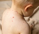 Measles outbreaks surge worldwide, driven by declining immunization coverage