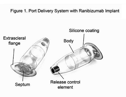 New implant technology safely minimizes injections for people with macular degeneration