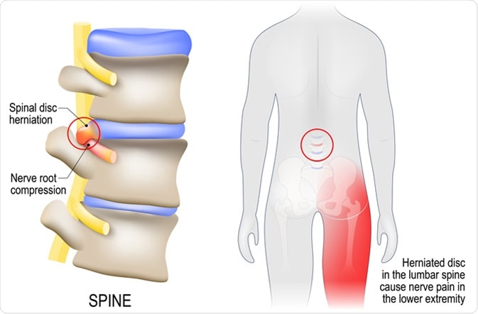 Sciatica diagram with vertebrae, disks and nerves - Image Credit: Designua / Shutterstock