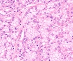 Acinic Cell Carcinoma