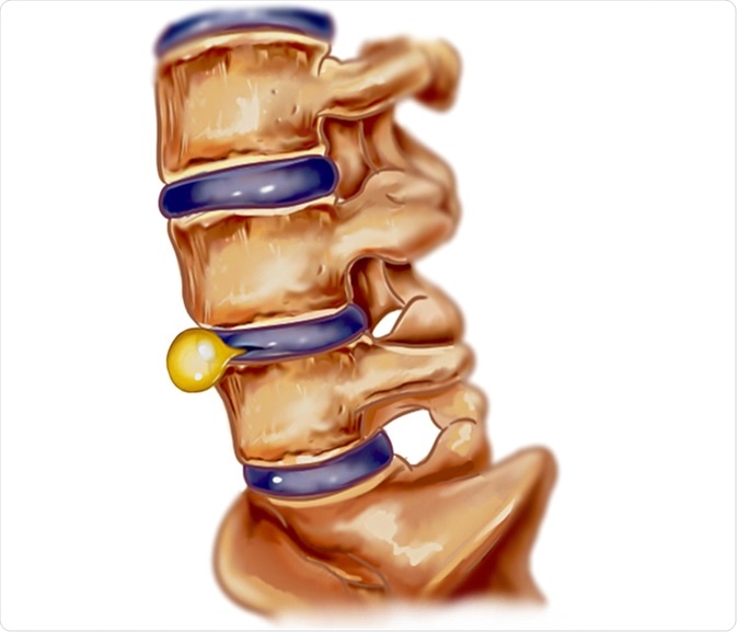Slipped disc illustration. Image Credit: corbac40 / Shutterstock