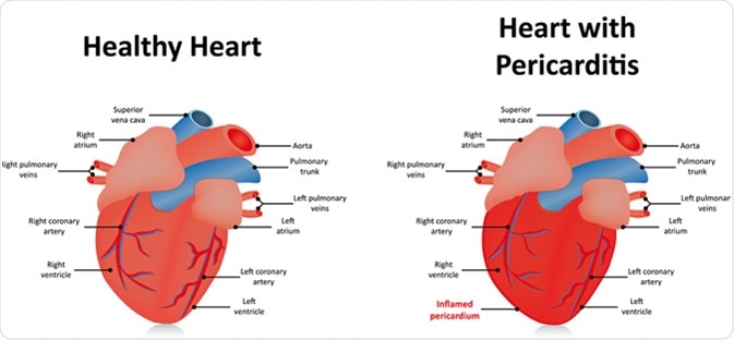 Pericarditis. Image Credit: Joshya / Shutterstock