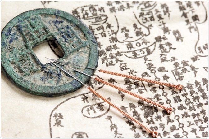 Acupuncture needles and ancient medicine illustration showing acupuncture points on human body - Image Credit: Pixeljoy / Shutterstock