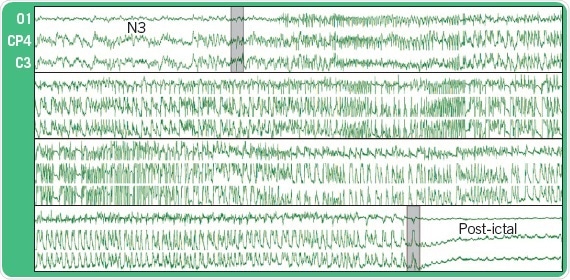 EEG recording from three epidural electrodes during an epileptic seizure in a rat. N3 refers to the phase of the sleep cycle during which the seizure occured.