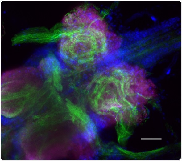 Neuronal gene mutations may be linked to seizures associated with Long QT Syndrome