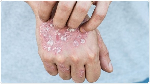 Johns Hopkins researchers estimate real-world prevalence of prurigo nodularis