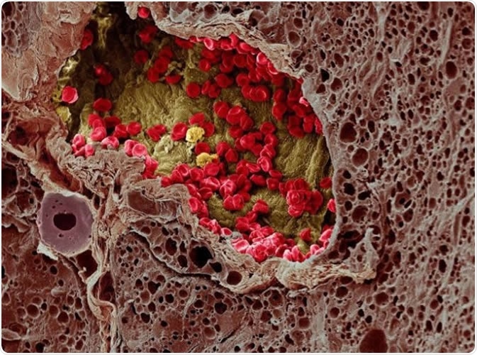A blood vessel (center) provides essential nutrients to a melanoma tumor (left) in this artificially colorized microscopy image. Image DOI: 10.7295W9CIL38960 Researchers at the University of Tokyo studied a cell membrane receptor, LRP1, and an enzyme, tPA, for their roles in metastasis of melanoma in mice. Image Credit: Wellcome Images CC-BY-NC-ND http://www.cellimagelibrary.org/images/38960