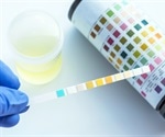 Urine Analysis / Urinalysis