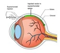 Johns Hopkins researchers develop new way to deliver sight-saving gene therapy to the retina