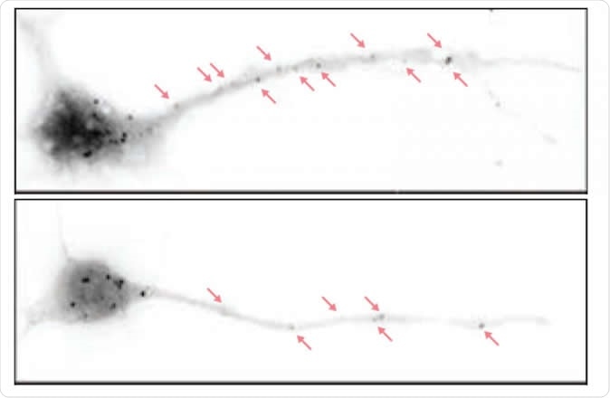 Depicted are hippocampal neurons from a normal mouse (above) and a mouse bred to lack the eIF4G microexon (below). In the latter, there are fewer particles representing paused protein synthesis machineries. In these mice, higher levels of protein synthesis in neurons lead to disrupted brain waves and autistic behaviors as well as cognitive deficits down the line. Image Credit: Thomas Gonatopoulos-Pournatzis
