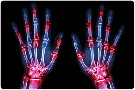 Arginine depletion could form the basis for potential rheumatoid arthritis therapies