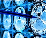 New AI tool predicts disease progression and evolution in neurodegenerative disorders
