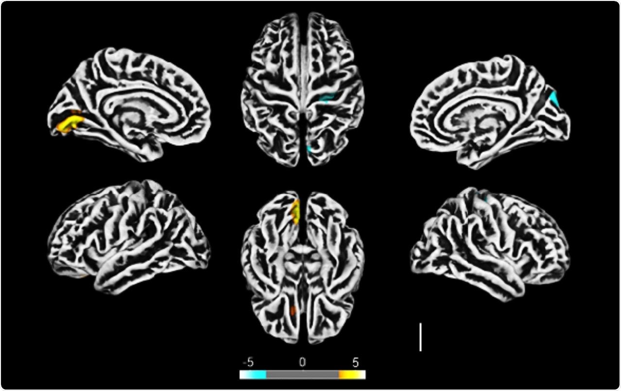 Altered cerebral cortical thickness is associated with neuropsychiatric symptoms in COVID-19 patients. a) Surface-based morphometry using high-resolution 3T MRI. Yellow represents areas of decreased cortical thickness: left lingual gyrus, calcarine sulcus (and cuneus), and olfactory sulcus (and rectus gyrus) . Blue represents areas of increased cortical thickness: central sulcus (precentral and postcentral gyrus) and superior occipital gyrus. Representative image of the analysis of 81 subjects tested positive for SARS-CoV-2 who had mild respiratory symptoms and did not require hospitalization or oxygen support compared to 145 healthy volunteers (without diagnosis of COVID-19) . The analysis was performed within a median interval of 54 days. b) Correlation between BAI performance and right orbital gyrus thickness. The data depicts Pearson’s correlation coefficient . c) Correlation between TRAIL B performance and right gyrus rectus thickness. Data depict Pearson’s correlation coefficient and region of interest in representative images.