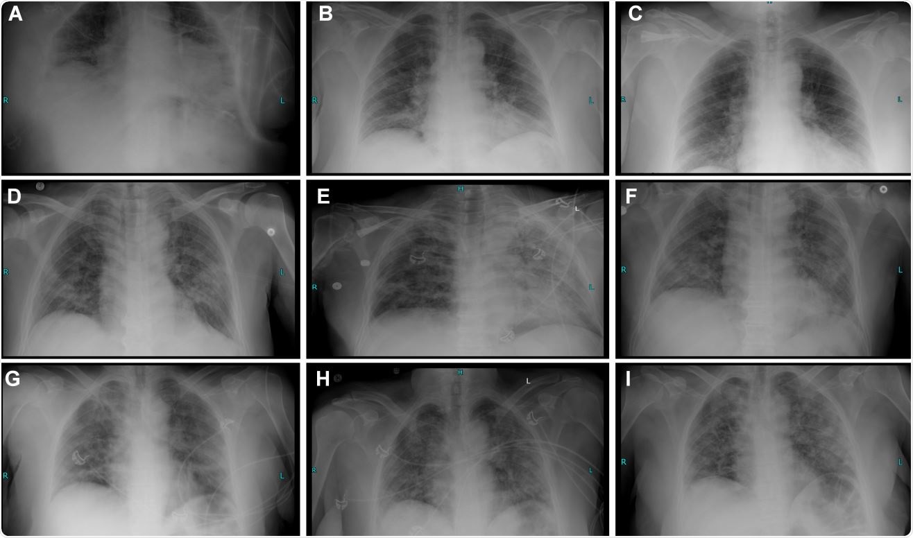 Radiography timeline and clinical course description of 3 COVID-19 cases treated with hemofiltration.