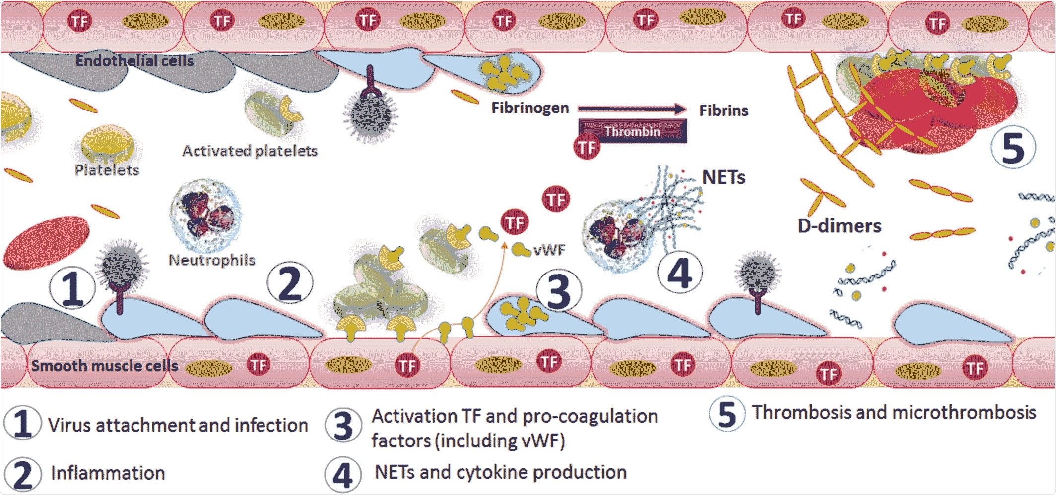 Mechanism of activation of coagulopathy in severe acute respiratory syndrome coronavirus 2 infection. Image Credit: John Wiley & Sons, Inc.
