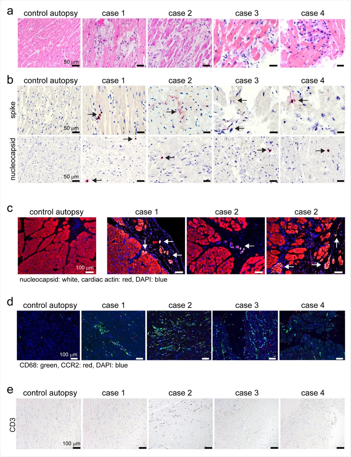 Human autopsy and endomyocardial tissue from patients with suspected COVID- 19 myocarditis show evidence of SARS-CoV-2 cardiomyocyte infection. a, Hematoxylin and eosin staining of cardiac autopsy (anterior left ventricular wall) and biopsy samples (right ventricular septum) from subjects without COVID-19 (control case) and patients with a clinical diagnosis of COVID-19 myocarditis (case 1-4). b, In situ hybridization of cardiac autopsy and biopsy tissue for SARS-CoV-2 spike and nucleocapsid RNA (red) showing evidence of viral infection. Hematoxylin: blue. Arrows denotes viral RNA staining in cells with cardiomyocyte morphology. c, Immunostaining of control and COVID-19 myocarditis cardiac autopsy tissue for SARS-CoV-2 nucleocapsid (white) and cardiac actin (red). DAPI: blue. Arrows denotes nucleocapsid staining in cardiomyocytes .d, Immunostaining of control and COVID-19 myocarditis cardiac autopsy and biopsy tissue for CD68 (green) and CCR2 (red). DAPI: blue. e, Immunostaining of control and COVID-19 myocarditis cardiac autopsy and biopsy tissue for CD3 (brown). Hematoxylin: blue.