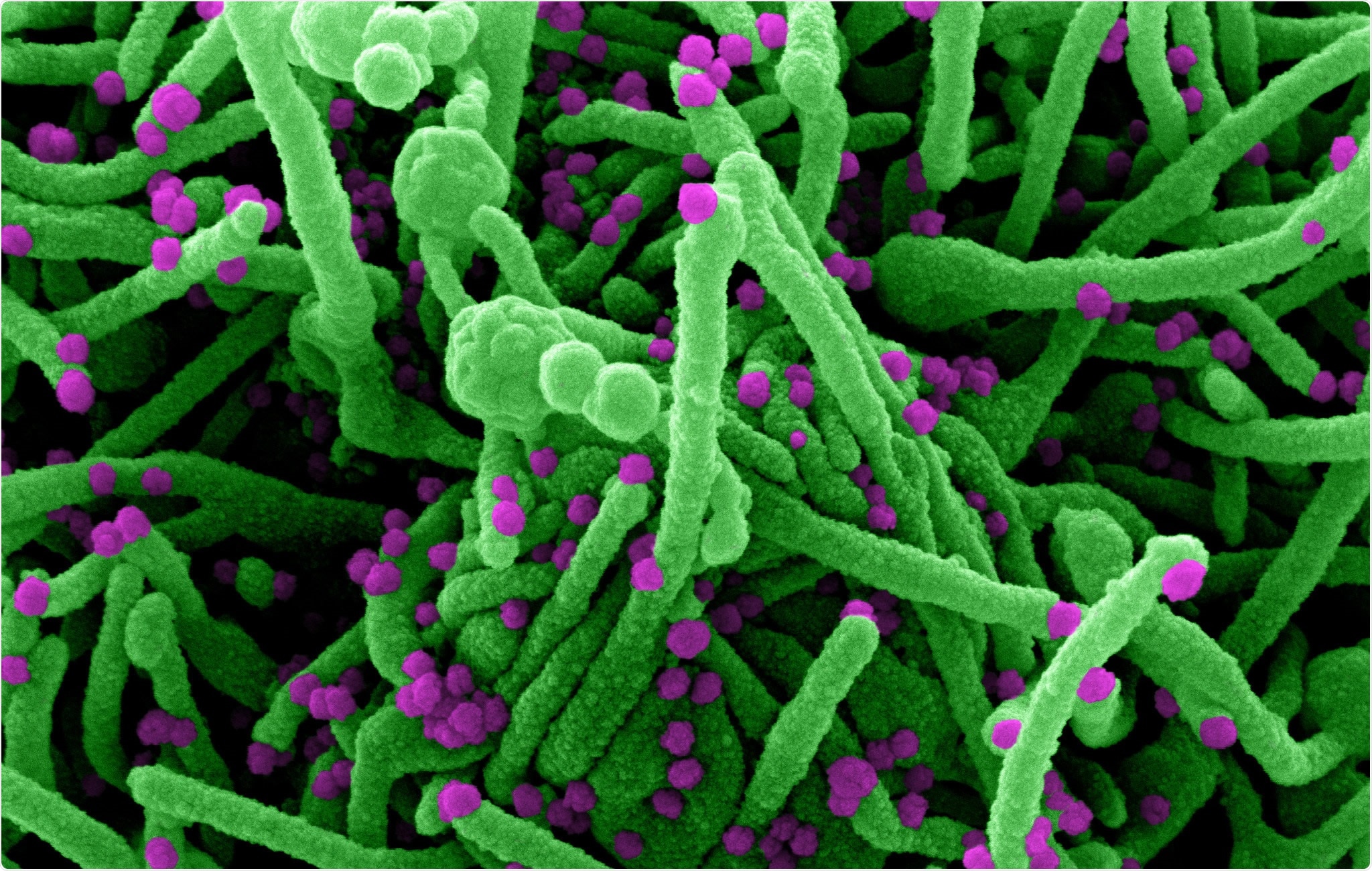 Study: Safety and efficacy of inhaled nebulized interferon beta-1a (SNG001) for treatment of SARS-CoV-2 infection: a randomized, double-blind, placebo-controlled, phase 2 trial.