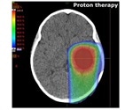 Researchers assess the risk of proton therapy for children with brain tumors
