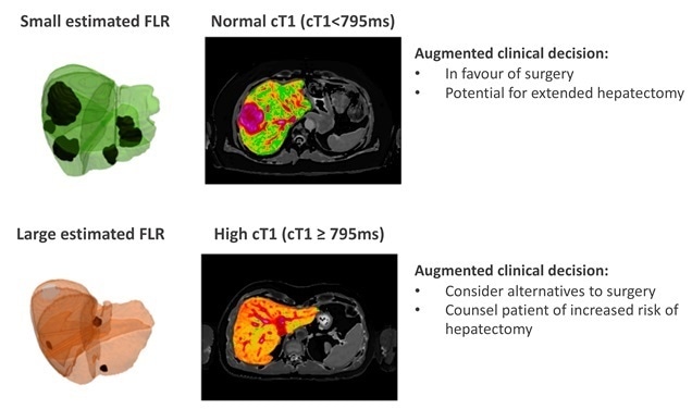 Non-invasive MRI technology helps improve surgical decision-making in liver cancer care